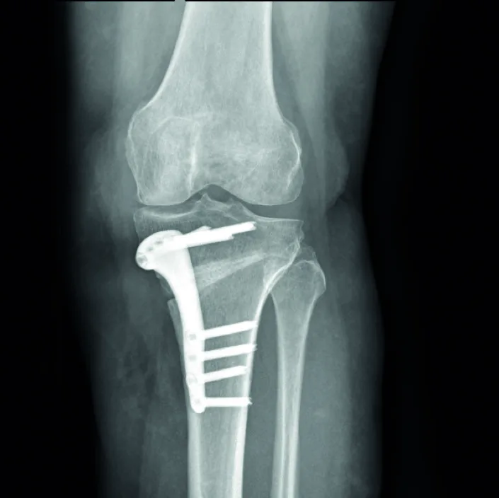 Preoperative xray 01
